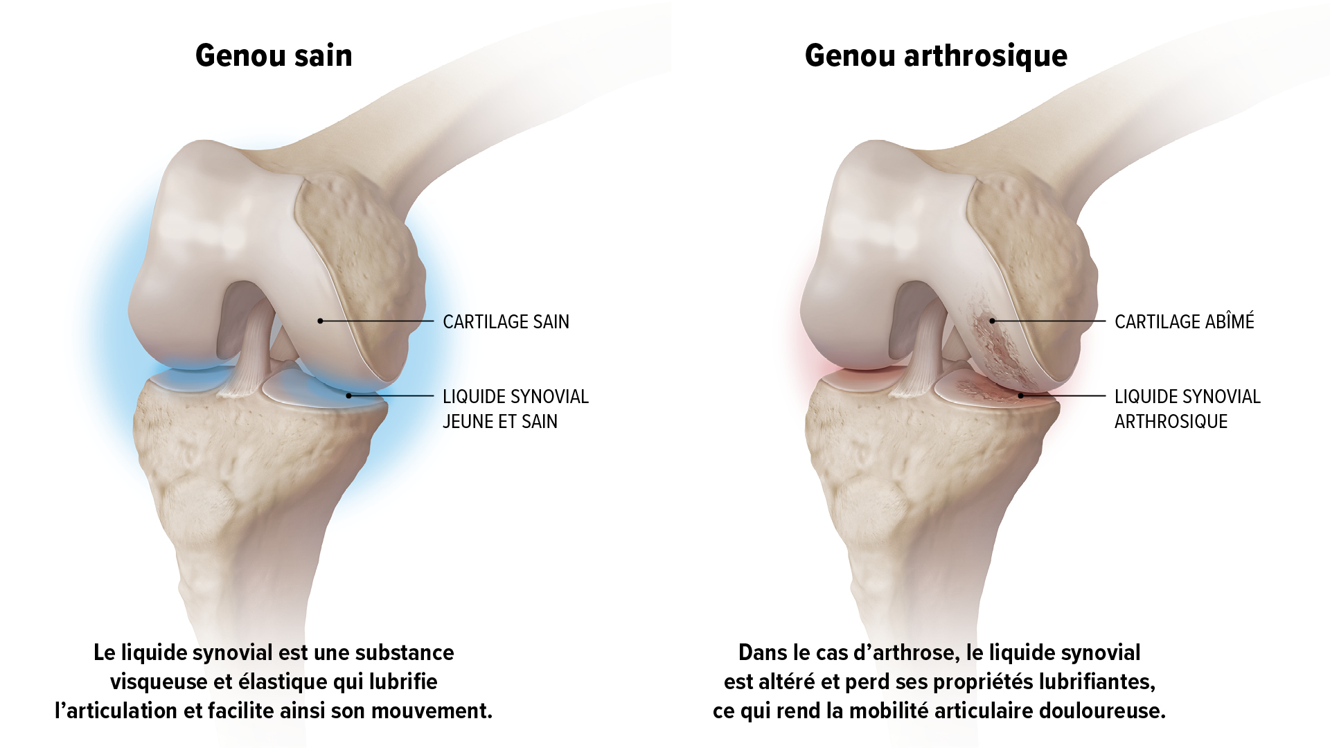 Viscosupplémentation pour l'arthrose du genou